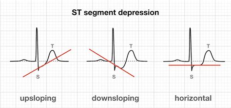 10. ST Segment Abnormalities .